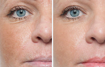 microneedling-before-and-after